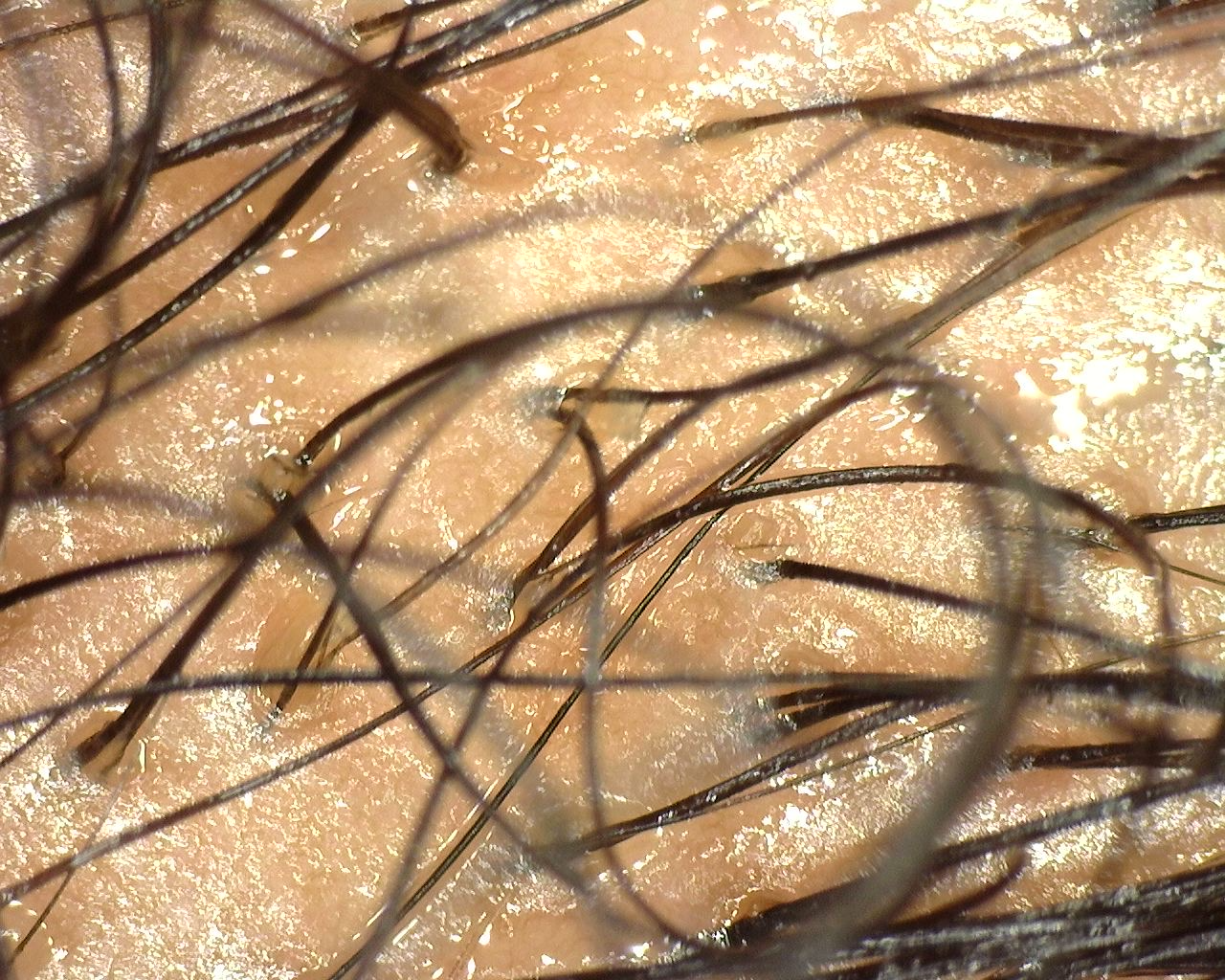 Cellustrious® Helping Scalp Calcification